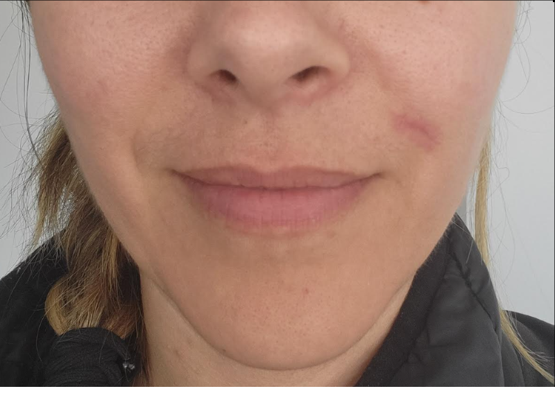 Cosmetic Mole Removal After