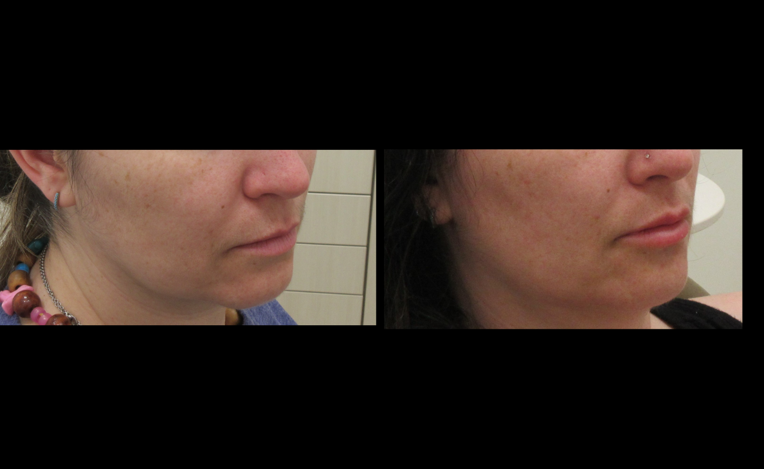  Soft Tissue Fillers Before & After