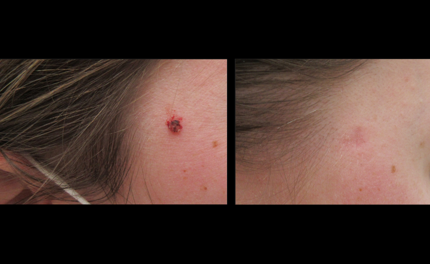 Cosmetic Mole Removal Before & After