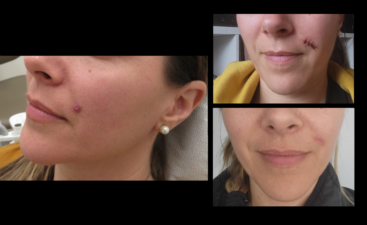 Cosmetic Mole Removal Before & After