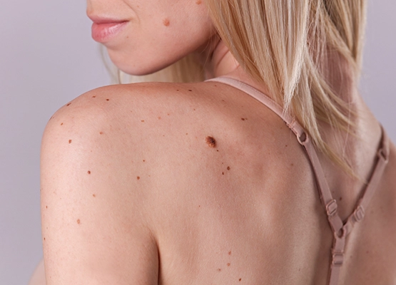 Affordable skin tag removal services in Ottawa Affordable skin tag removal services in Ottawa