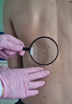 cosmetic-mole-removal-2 Cosmetic mole and skin tag removal clinic in Ottawa