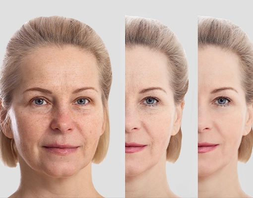 Neuromodulator treatments explained for Ottawa residents Neuromodulator treatments explained for Ottawa residents